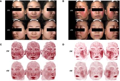 Treatment of rosacea with upadacitinib and abrocitinib: case report and review of evidence for Janus kinase inhibition in rosacea
